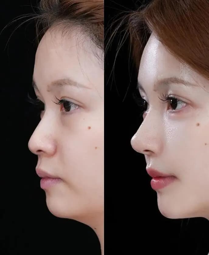 Cartilage Rhinoplasty
